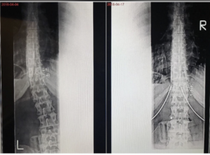 after spine therapy x ray